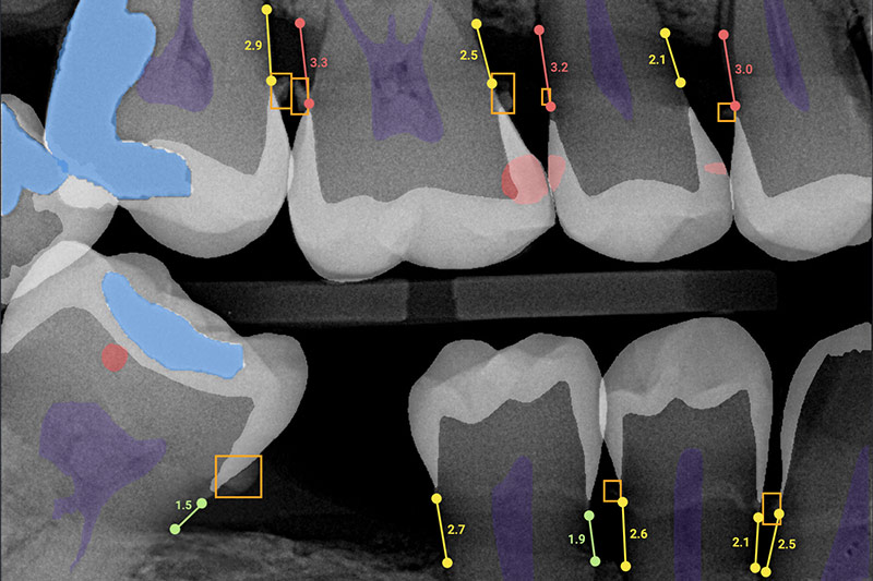 Digital X-Rays in 